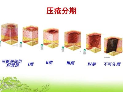 壓瘡的分期及臨床表現最新版